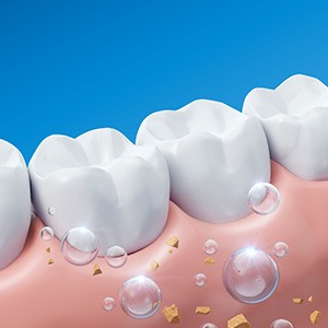 Illustration of bubbles pulling minerals toward teeth