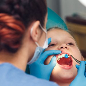Dentist applying blue fluoride to patient’s teeth
